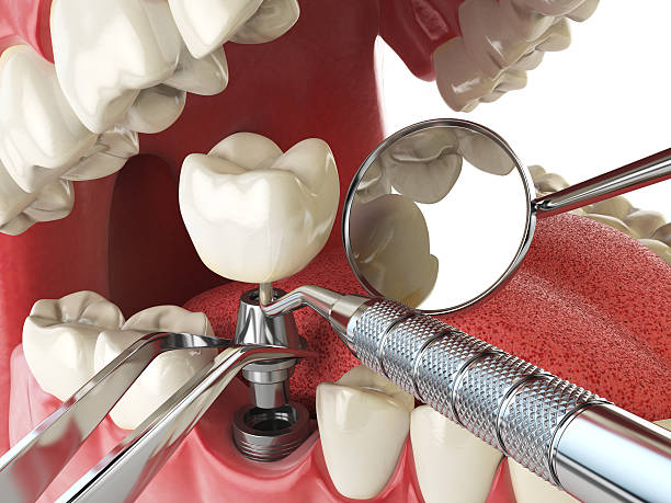 Best Emergency Wisdom Tooth Extraction in North Fair Oaks, CA